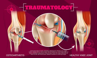 3d gerçekçi illüstrasyon Travmatoloji tıpta. Vektör Banner görüntü anatomi insan diz eklem tedavi osteoartrit enjeksiyon uyuşturucu yöntemi enjekte. Sağlıklı diz eklem sonucu tıbbi tedavi