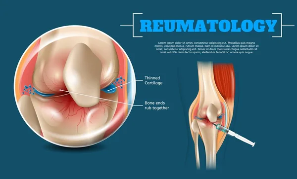 Realistisch Beeld Voordelen Juiste Injectieplaats Banner Reumatology Anatomie Menselijke Knie — Stockvector