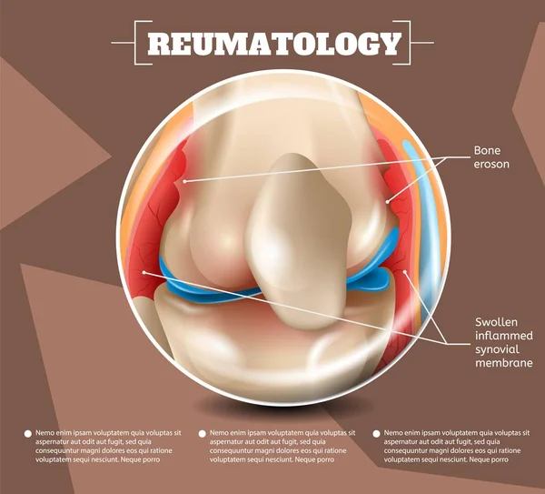 Realistyczne Ilustracja Medycyna Reumatology Wektor Obraz Banner Anatomia Medycznych Struktura — Wektor stockowy