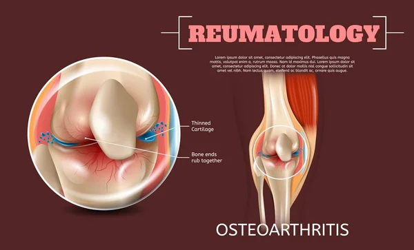 현실적인 관절염 합동입니다 이미지 Reumatology 해부학 인간의 무릎입니다 남았다 끝납니다 — 스톡 벡터