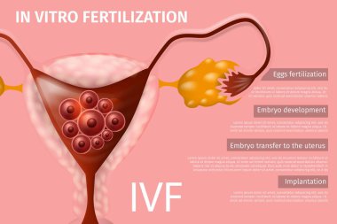 İn Vitro fertilizasyon, implantasyon kadının yumurta
