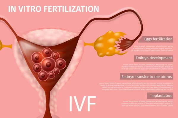 Ovos de mulheres in vitro Fertilização, Implantação —  Vetores de Stock