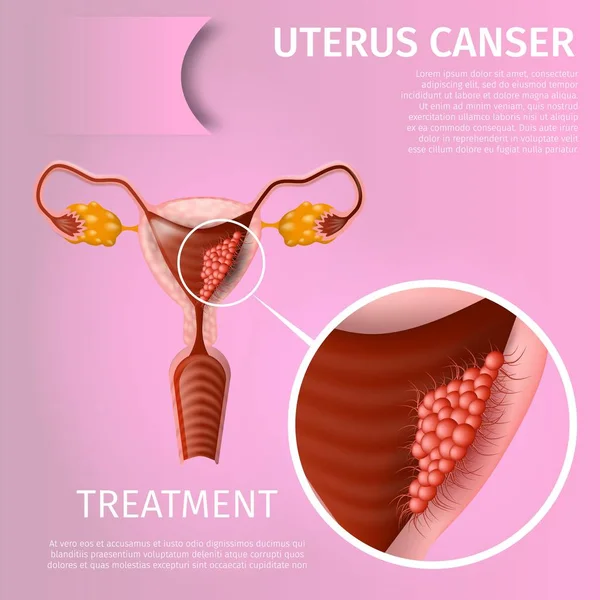 Trastorno oncológico del sistema reproductivo femenino — Vector de stock