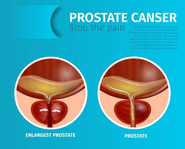 Medical Banner with Normal and Enlargest Prostate. clipart