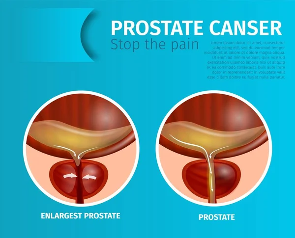 Medizinisches Banner mit normaler und vergrößerter Prostata. — Stockvektor