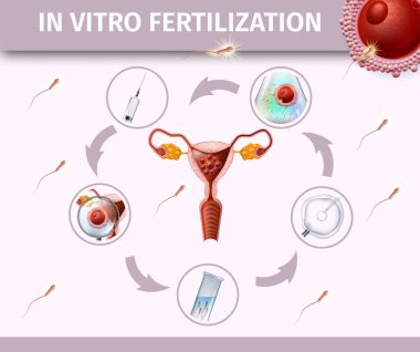 In vitro fertilizasyon, uterusun renkli poster