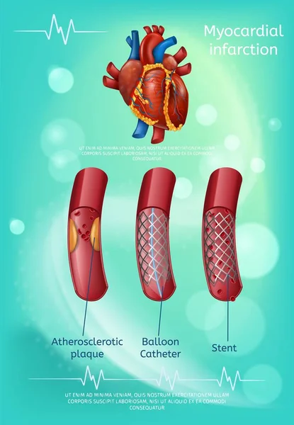 Trattamento Metodi di infarto miocardico Banner — Vettoriale Stock