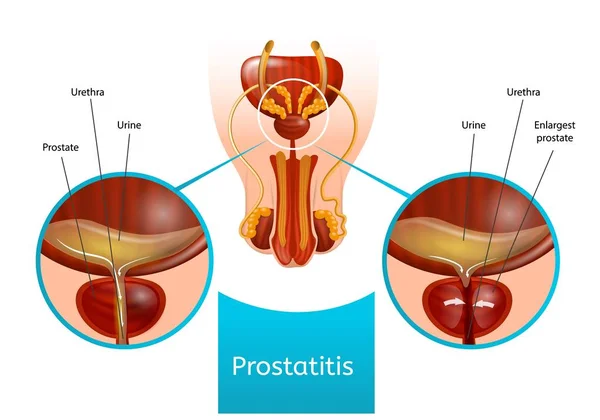 Esquema de prostatitis con sistema reproductor masculino — Vector de stock