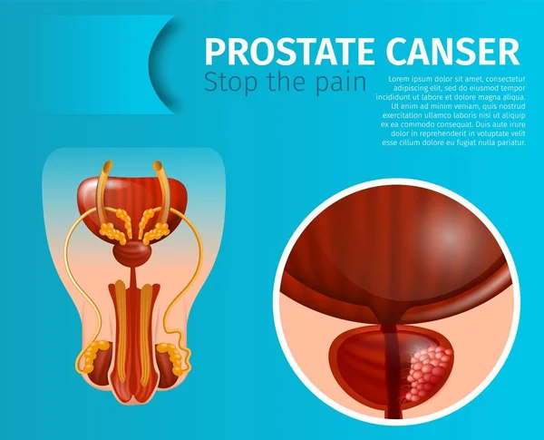 Prostat bezi Banner kanserli tümör hücreleri — Stok Vektör