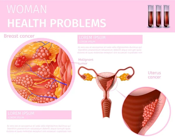 Breast Cancer Medical Vector Chart With Human Female Breast