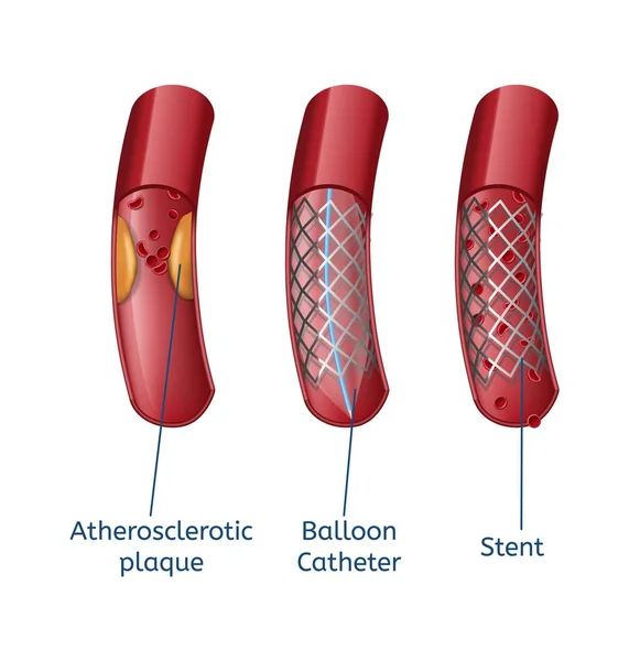 Penghapusan Atherosclerosis Presentasi realistis - Stok Vektor