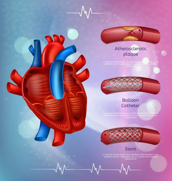 วิธีการรักษา Atherosclerosis แบนเนอร์ทางการแพทย์ — ภาพเวกเตอร์สต็อก