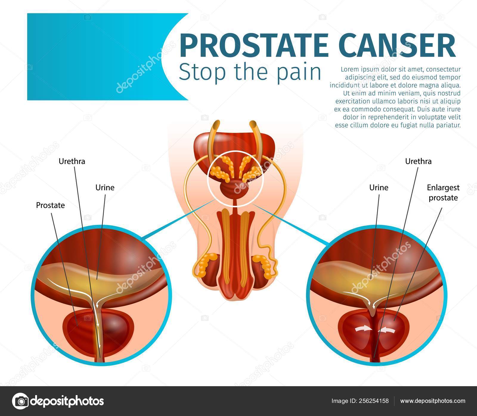 tumore prostata dolores tumore prostata dolores