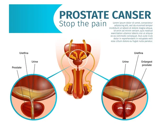 Prostaatkanker. Kankercellen in de klier. — Stockvector