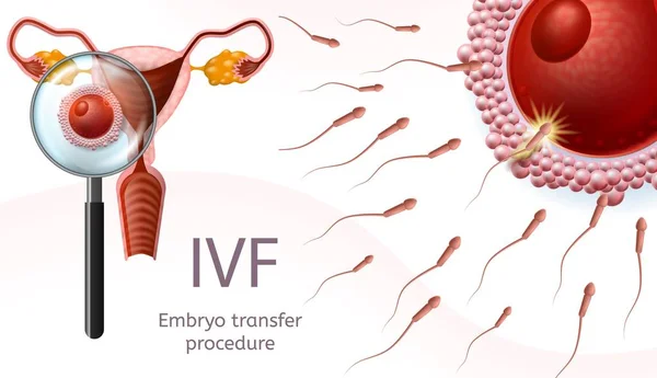 Zapłodnienia in vitro. Procedura przeniesienia embrionów — Wektor stockowy