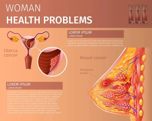 Transtorno Oncológico do Sistema Reprodutor Feminino —  Vetores de Stock