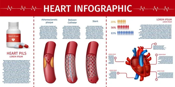 심장과 심혈 관 치료 인포 그래픽 페이지 — 스톡 벡터
