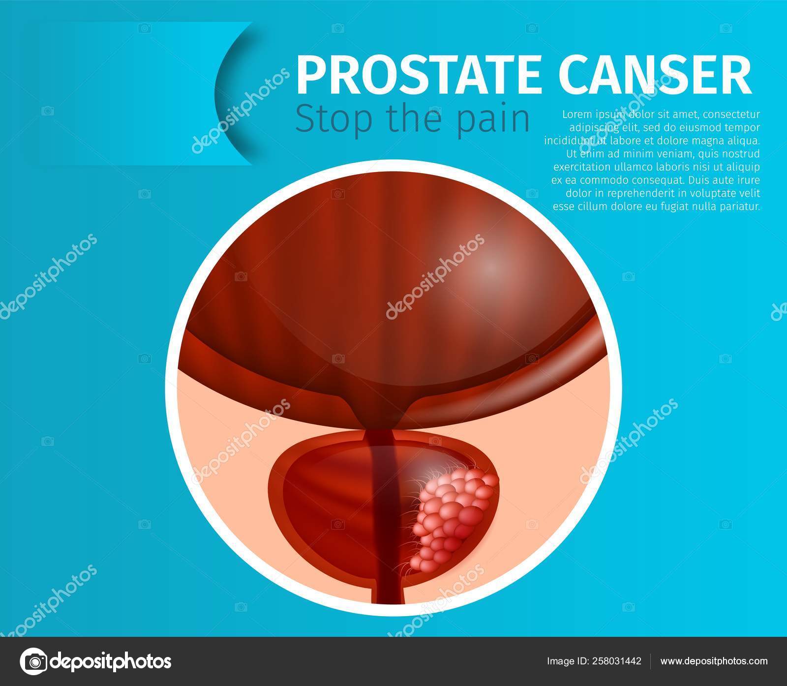 Prostatitis vesiculitis népi jogorvoslatok