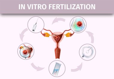 İnsan In Vitro Fertilizasyon Aşamaları Infografik.