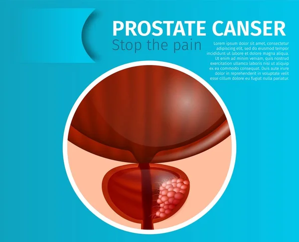 Prostatakrebs. Schluss mit dem urologischen Schmerzbanner. — Stockvektor
