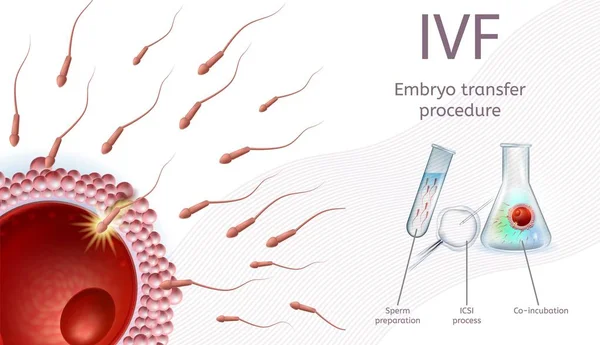 Fertilização In Vitro Embrião Procedimento de Transferência . —  Vetores de Stock