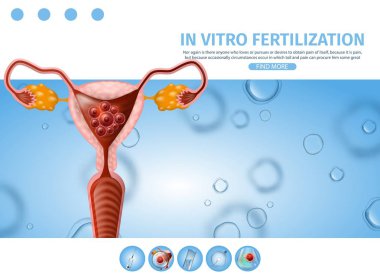 In Vitro Fertilizasyon Bilgi Yardımı Afişi.