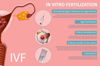 In Vitro Fertilizasyon Tıbbi Banner Aşamaları