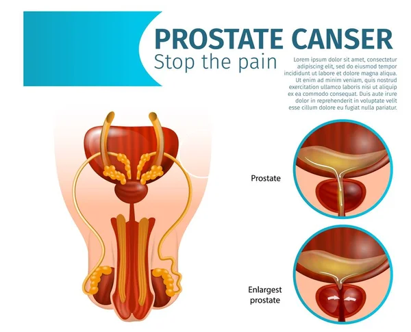 Gesunde und entzündete Prostata. Krebs. — Stockvektor