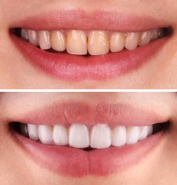 Gülümseyen genç bir kadını ağartma işleminden önce ve sonra mükemmel bir gülümseme. Diş Sağlığı Kliniği Hastası. Diş bakımı, stomatoloji ve diş hekimliğinin sonucu.