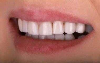 Mükemmel sağlıklı dişler güzel geniş gülümseme ağartma prosedürü genç gülümseyen seksi dudaklı kadının beyazlatılması. Diş Yenileme Tedavisi Oral Bakım Diş Hekimliği, Stomatoloji Dişçiliği 