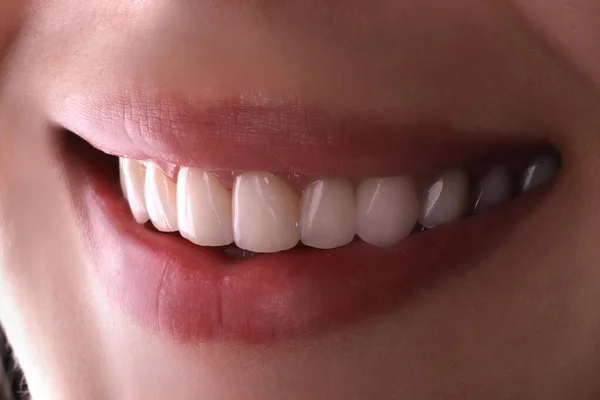 Dientes Sanos Perfectos Hermosa Sonrisa Ancha Blanqueamiento Procedimiento Blanqueamiento Joven —  Fotos de Stock