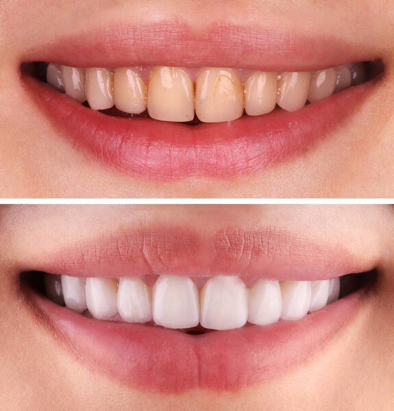 Perfect smile before and after bleaching procedure whitening of young happy smiling woman . Dental restoration treatment clinic patient.Demonstration result of oral care dentistry, stomatology