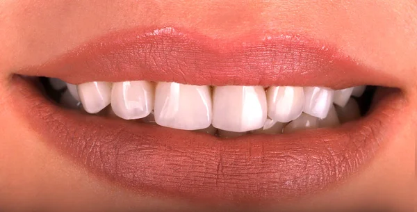 Perfetti Denti Sani Bella Procedura Sbiancamento Sorriso Ampio Sbiancamento Della — Foto Stock