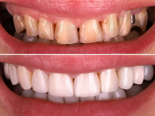漂白前和漂白后完美的微笑使年轻快乐的微笑女人白皙 牙科康复治疗诊所病人 口腔科 口腔科证明结果 — 图库照片