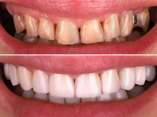 Gülümseyen genç bir kadını ağartma işleminden önce ve sonra mükemmel bir gülümseme. Diş Sağlığı Kliniği Hastası. Diş bakımı, stomatoloji ve diş hekimliğinin sonucu.