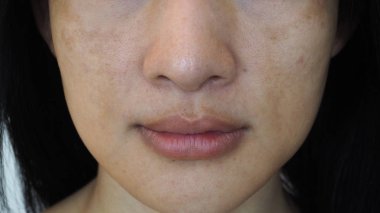Asyalı kadın koyu lekeleri ve çiller sorunları ile closeup.