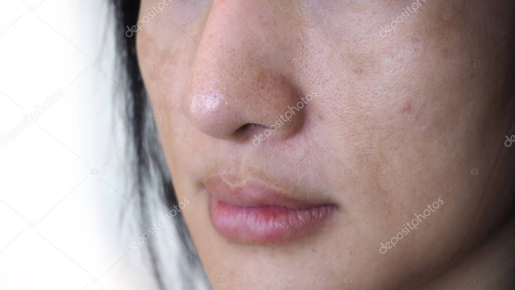 Closeup of Asian woman with dark spots and freckles problems.