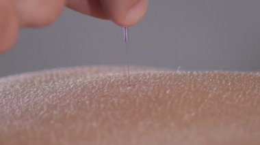 Acupuncturist removing acupuncture needle in a acupuncture session