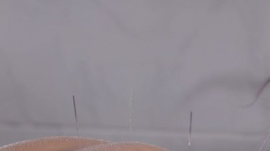 Acupuncturist removing acupuncture needles in a acupuncture session
