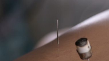 Akapunkturcu akupunktur iğnesine moxa uyguluyor.