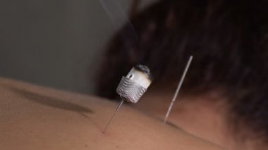 Moxa dumanlı akupunktur iğnesi bir kadının sırtını uyarır.