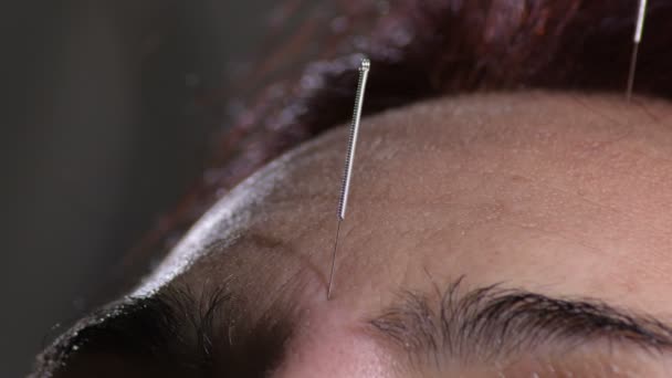鍼治療の針で患者の顔の前 — ストック動画