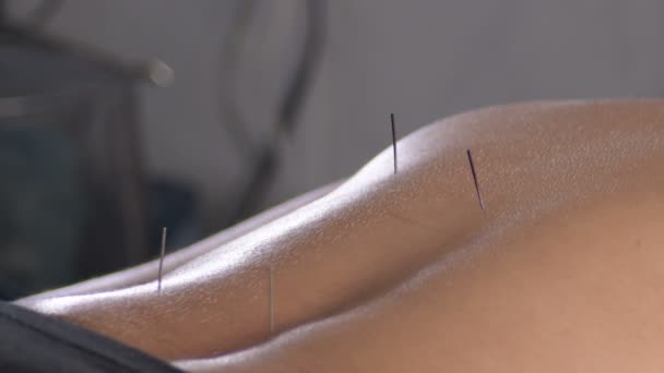 Acupuncturist Verwijdert Acupunctuurnaalden Van Rug Van Een Vrouw — Stockvideo