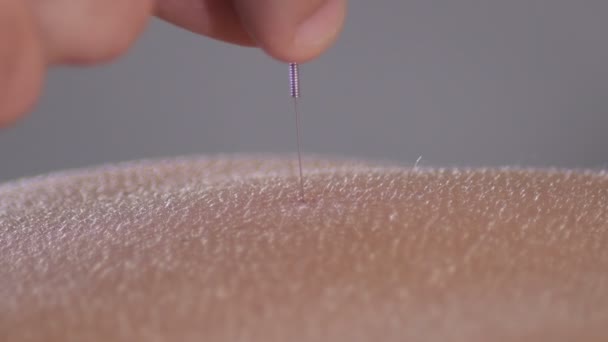 Acupuncturist Removing Acupuncture Needle Acupuncture Session — Stock Video