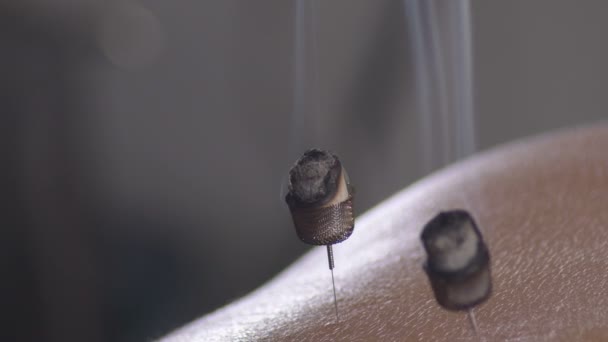 Aiguilles Acupuncture Avec Moxas Fumant Stimulant Dans Une Séance Moxibustion — Video