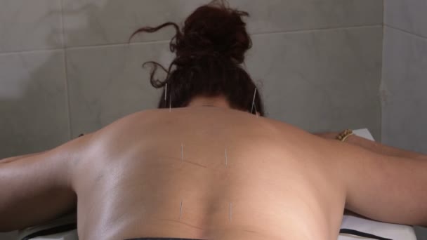 Back Woman Acupuncture Needles Spikes — ストック動画