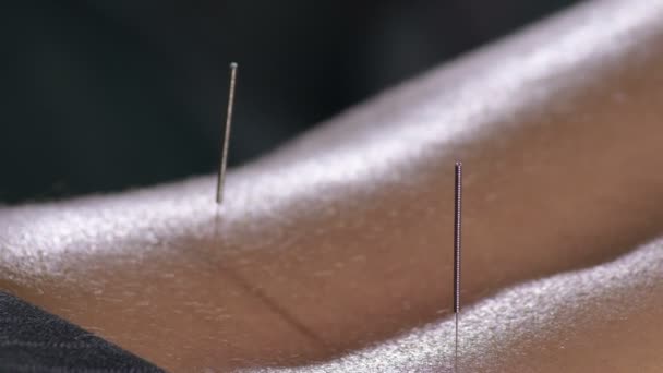 Acupuncture Needles Back Woman Acupuncture Session — Stock Video