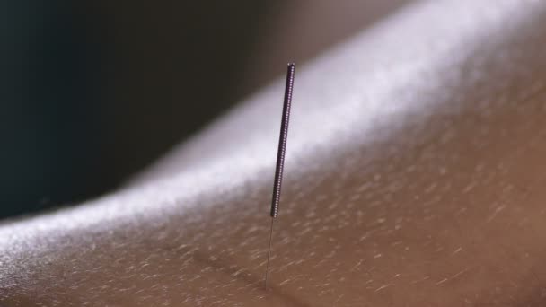 Acupuncture Needle Spike Back Woman Acupuncture Session — Stock Video