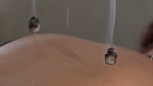 Akupunkční Jehly Moxas Kouřem Stimulující Záda Pacienta — Stock video