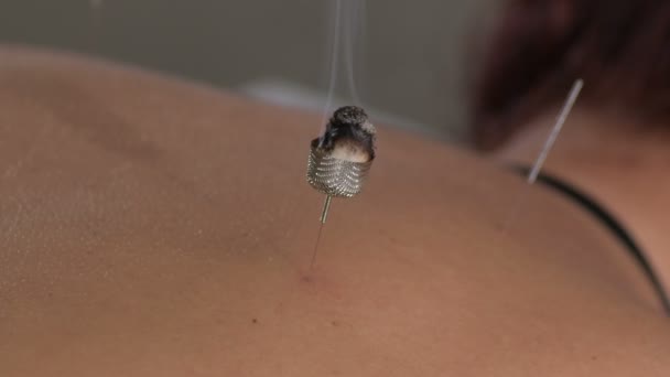 Akupunkturnadel Mit Moxa Rauch Die Den Rücken Eines Patienten Stimuliert — Stockvideo